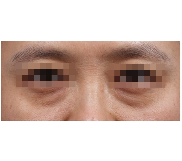 하안검 필러 (눈물고랑 필러) 시술 전 사진