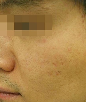 알라딘 필링 시술 후 사진