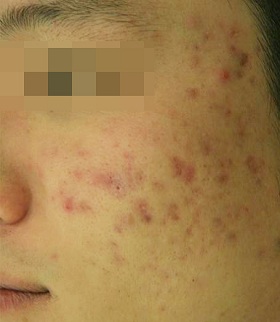 알라딘 필링 시술 전 사진