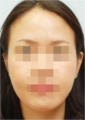 턱보톡스 시술 후 사진