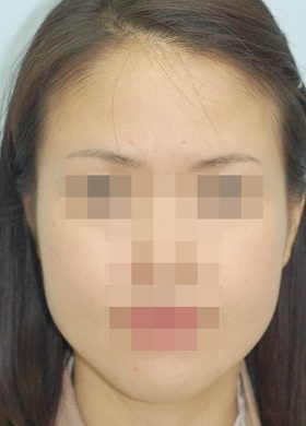 턱보톡스 시술 전 사진