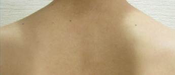 알라딘 필링 시술 후 사진