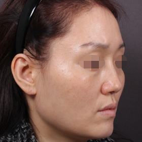 필러 After