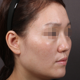 필러 Before