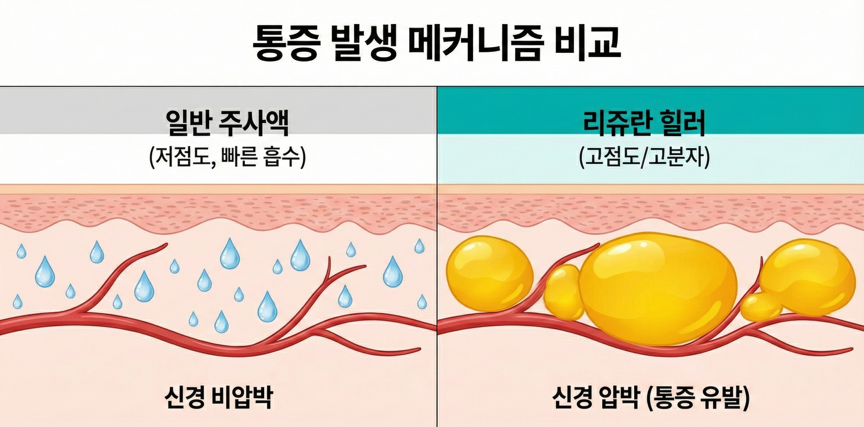 리쥬란 힐러 통증 원인