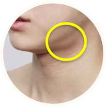 턱밑 침샘 비대형