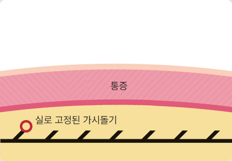 자연스러운 리프팅