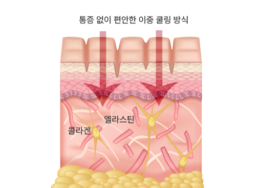 튠페이스 시술 과정
